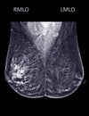 X-ray Digital Mammogram or mammography of both side breast Standard views are  mediolateral oblique (MLO) views Royalty Free Stock Photo