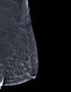 X-ray Digital Mammogram or mammography of both side breast Standard views are  mediolateral oblique (MLO) views Royalty Free Stock Photo