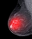 X-ray Digital Mammogram or mammography of both side breast Standard views are  mediolateral oblique (MLO) views Royalty Free Stock Photo