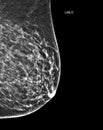 X-ray Digital Mammogram or mammography of both side breast Standard views are  mediolateral oblique (MLO) views Royalty Free Stock Photo