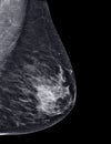 X-ray Digital Mammogram or mammography of both side breast Standard views are  mediolateral oblique (MLO) views Royalty Free Stock Photo