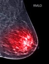 X-ray Digital Mammogram or mammography of both side breast Standard views are  mediolateral oblique (MLO) views Royalty Free Stock Photo