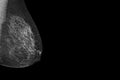 X-ray Digital Mammogram or mammography  image MLO view  for screening  Breast cancer. Royalty Free Stock Photo