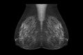 X-ray Digital Mammogram or mammography image MLO view .