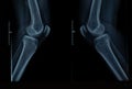 X-ray of knee joints