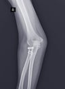 X-ray Elbow joint.After open reduction and internal fixation for radial head with Leibinger plate and repair of lateral ulnar Royalty Free Stock Photo