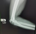 X-ray Elbow lateral view fracture . Royalty Free Stock Photo