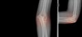 X-ray elbow showing fracture proximal Ulna or Olecranon fracture treated by surgery with tension band wiring fixationTBW.