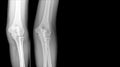 X-ray elbow showing fracture proximal Ulna or Olecranon fracture treated by surgery with tension band wiring fixationTBW.