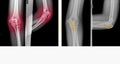 X-ray elbow showing fracture proximal Ulna or Olecranon fracture treated by surgery with tension band wiring fixationTBW.