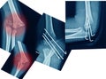 X-ray elbow showing Supracondylar humerus fracture and post opretion fix K-wire