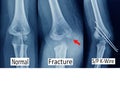 X-ray elbow showing Supracondylar humerus fracture and post opretion fix K-wire