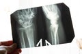 X-ray of an elderly person with osteoporosis and arthritis arthrosis, bone destruction Royalty Free Stock Photo