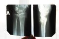 X-ray of an elderly person with osteoporosis and arthritis arthrosis, bone destruction