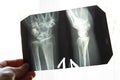 X-ray of an elderly person with osteoporosis and arthritis arthrosis, bone destruction Royalty Free Stock Photo