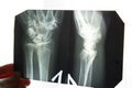 X-ray of an elderly person with osteoporosis and arthritis arthrosis, bone destruction Royalty Free Stock Photo