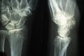 X-ray of an elderly person with osteoporosis and arthritis arthrosis, bone destruction Royalty Free Stock Photo