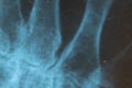 X-ray of an elderly person with osteoporosis and arthritis arthrosis, bone destruction Royalty Free Stock Photo