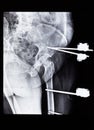 X-ray with external fixation device fixed in bones