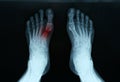 X ray of feet with tarsal fracture closeup