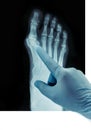 X-ray of the feet valgus deformity of the toe or a bone on a finger