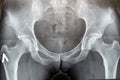 X-ray of the female hip joint, female problems, uterine and ovarian problems, arthritis and arthrosis of the joints a Royalty Free Stock Photo