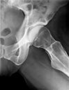 X-Ray of female Left Hip.