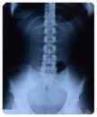 X-RAY of female lower thorax and pelvis