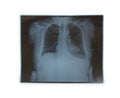 X-ray film of chest Royalty Free Stock Photo