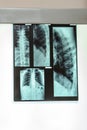 X-ray film of chest spine and lungs