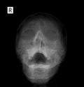 X-ray film of the face - frontal, nose-chin projection. Pansinusitis. Royalty Free Stock Photo