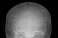 X-ray film of the head of a small child.Blurred of roentgen skull.Front view. Close up.Medicine and health care,concept check,