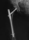 X-ray film of a hip joint with fixing of bones