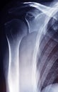 X ray film of human shoulder