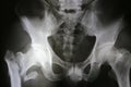 X-ray film of intrinsic hip and pelvic pain isolated on black ba Royalty Free Stock Photo