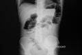 x-ray film of a patient with bowel obstruction Royalty Free Stock Photo