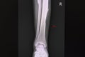 X-ray film of a patient with spiral fracture of right tibia Royalty Free Stock Photo