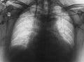 X-ray film of patient with lung disease Royalty Free Stock Photo