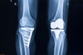 X-ray film of a patient with total left knee replacement Royalty Free Stock Photo