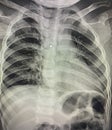 X-ray film rib bone shot from film display Royalty Free Stock Photo