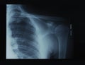 X-ray film of shoulder