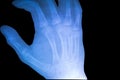 X-ray film show normal human's hand right.