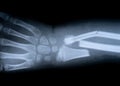 X-ray film skeleton human arm. health medical anatomy body concept Royalty Free Stock Photo