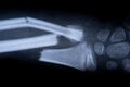 X-ray film skeleton human arm. health medical anatomy body concept