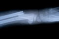 X-ray film skeleton human arm. health medical anatomy body concept