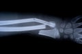 X-ray film skeleton human arm. health medical anatomy body concept