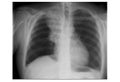 An x-ray film taken on a pair of lungs with cancerous cells Royalty Free Stock Photo