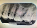 The X-ray film of teeth diagnosed in the dental clinic of Thailand Bangkok; Thailand December 1, 2018