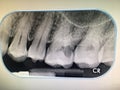 The X-ray film of teeth diagnosed in the dental clinic of Thailand Bangkok; Thailand December 1, 2018