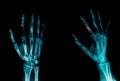 Fracture in dex finger x-ray Royalty Free Stock Photo
